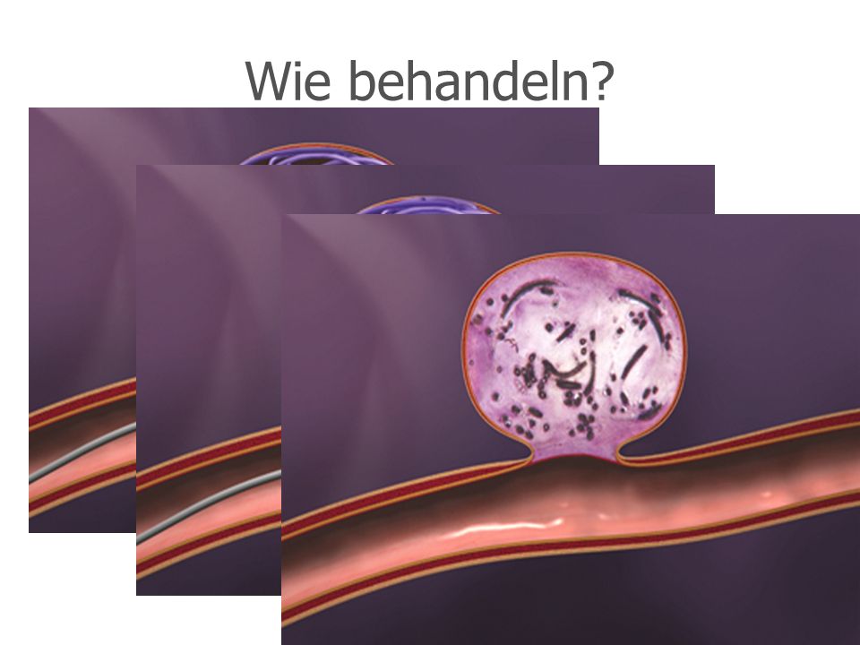 Die kleinen Nägel die Behandlung